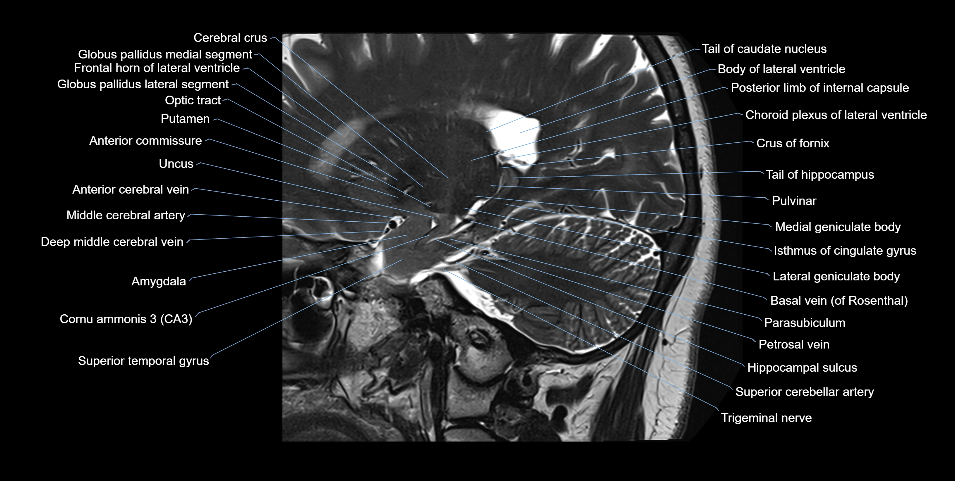 hippocampus sagittal cross sectional anatomy 3T MRI images -img-10009.webp